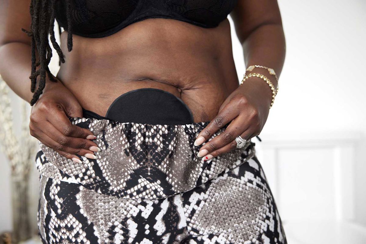 SenSura® Mio ostomy bags and plates